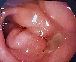 消化性潰瘍內視鏡照片